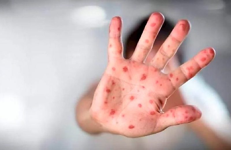 Mato Grosso ultrapassa 100 casos confirmados de meningite em 2026 e registra 16 mortes pela doença 670d9fcb1fa101eed3bf08fe1d6dc34f semana7 com br