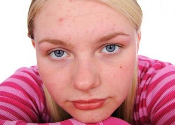 Saiba como evitar aparecimento e amenizar efeitos de cravos e acne Foto4215