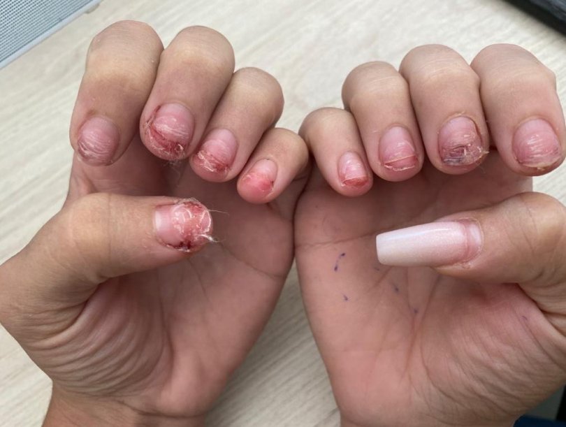 Adolescente de 16 anos tem unhas arrancadas pelo marido durante briga Foto11777