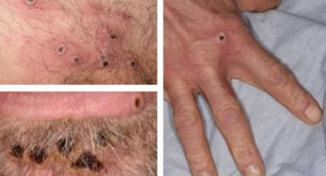 Paciente internado com suspeita de varíola do macaco viajou para países com surto da doença Foto92110