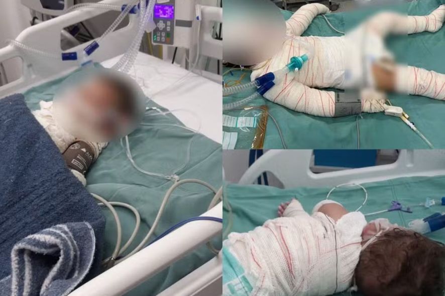 Bebê atingido por explosão de churrasqueira morre com queimaduras de 3º grau Foto42908