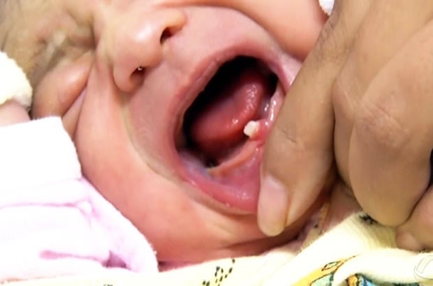 Em caso raro, bebê nasce com dente formado em cidade de Mato Grosso Foto97709