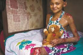Menina com doença rara de pele pede ajuda Foto45668